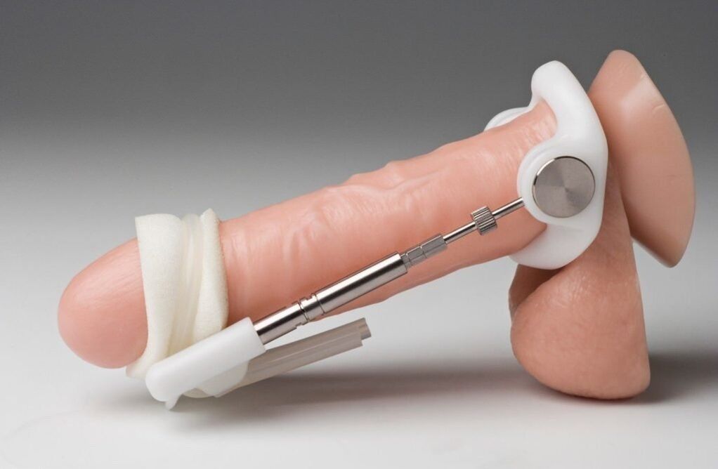 Expansion to increase penis thickness